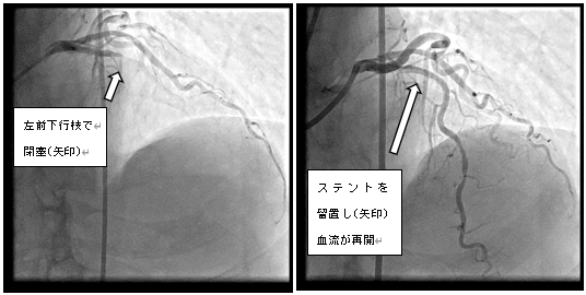 急性心筋梗塞　左冠動脈前下行枝へのPCI