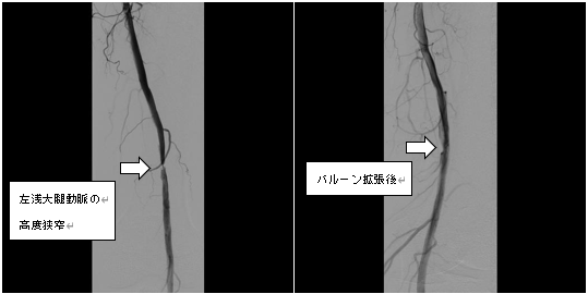 左下肢閉塞性動脈硬化症　左浅大腿動脈遠位部へEVT