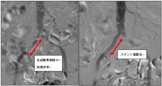 右下肢閉塞性動脈硬化症　右総腸骨動脈へ炭酸ガスを用いたEVT