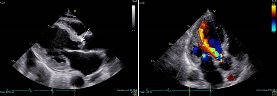 感染性心内膜炎による大動脈弁閉鎖不全症、うっ血性心不全の経胸壁心エコー像