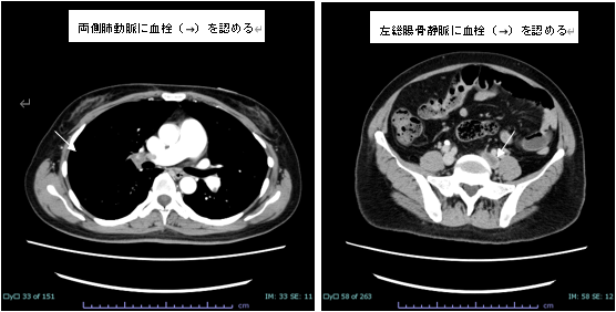 肺血栓塞栓症・下肢静脈血栓症