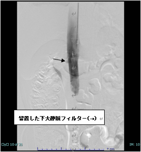 肺血栓塞栓症・下肢静脈血栓症