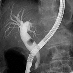 内視鏡的逆行性胆管膵管造影検査（ERCP）