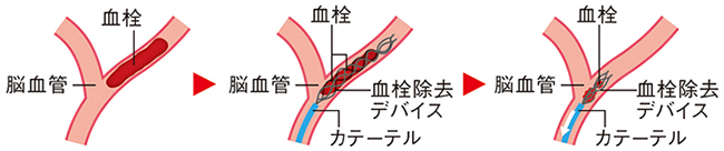 カテーテル治療（血栓回収療法）