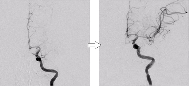 カテーテル治療（血栓回収療法）実際の画像