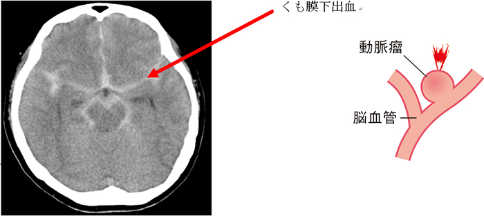 くも膜下出血