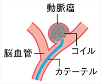 コイル塞栓術