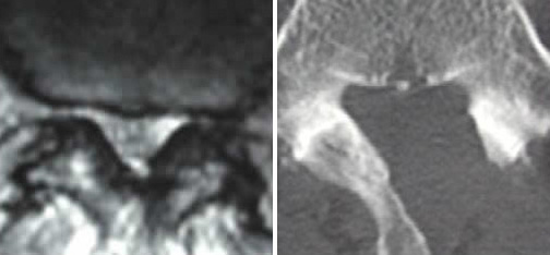 腰部脊柱管狭窄症に対する顕微鏡視下手術
