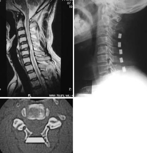 頸椎に対する脊柱管拡大術